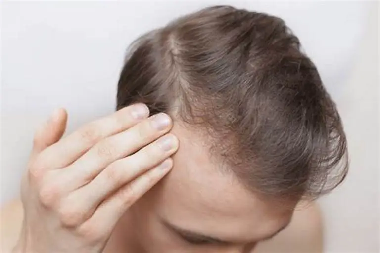 Does Mounjaro Cause Hair Loss
